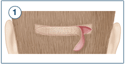 hartransplantasjon - STRIP-metoden