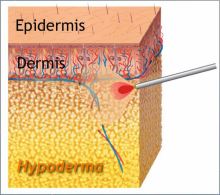 Laserfettsuging (SmartLipo/laserfettfjerning)