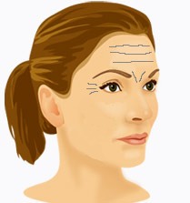 Alt om Botox (Vistabel/Dysport)